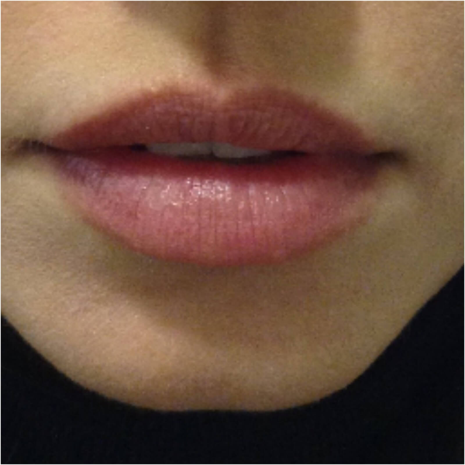עיצוב שפתיים עם חומצה היאלורונית