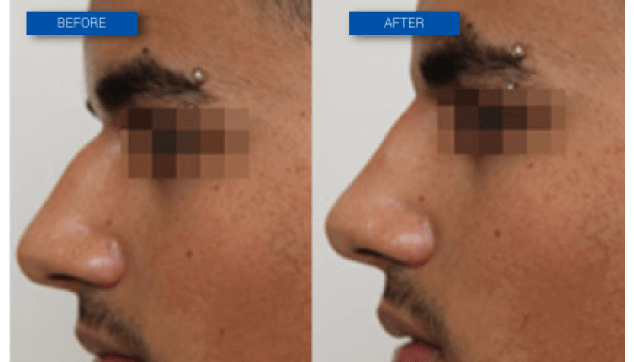 שיפור בצורת האף ללא ניתוח